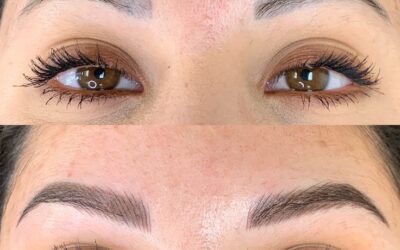 🩺 راهنمای حذف ایمن تتو و میکروپیگمنتیشن برای بیماران سرطانی 🎗